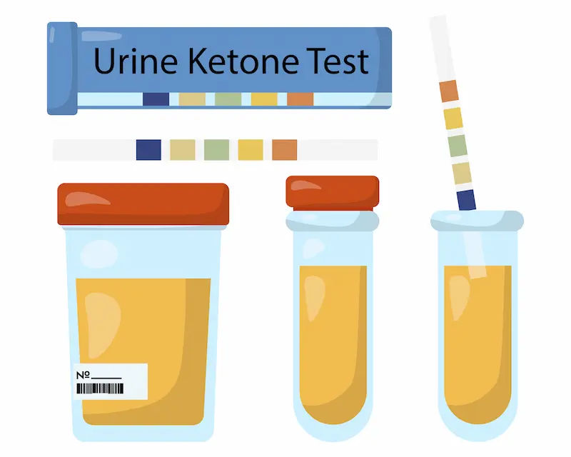 Ketones in Urine Causes, Symptoms, and When to Worry